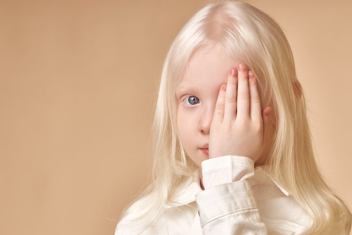 albinism همه چیز در مورد رنگ پوست : رنگدانه‌ها چه تاثیری در پوست دارند